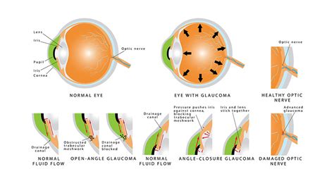 Acute angle closure Glaucoma | IrisTech