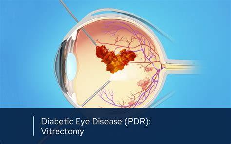 Vitrectomy Surgery | Retinal Consultants Medical Group