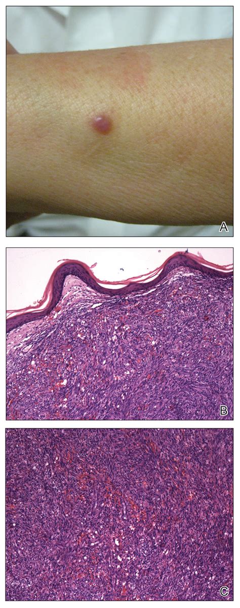 Kaposi Sarcoma Rash