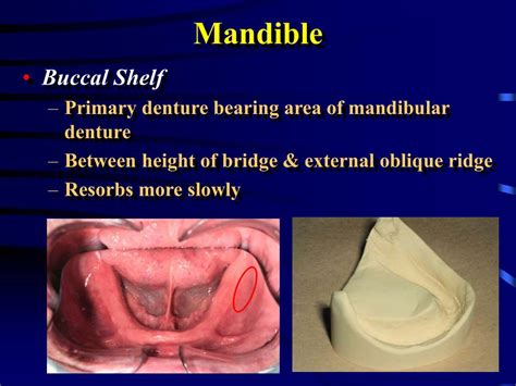 PPT - Anatomy for Complete and Partial Dentures PowerPoint Presentation ...