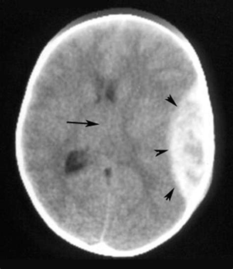 intracranial Hemorrhage