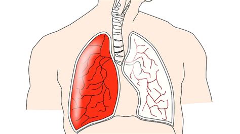 Lung disease's early warning symptoms get ignored. Watch out for these ...