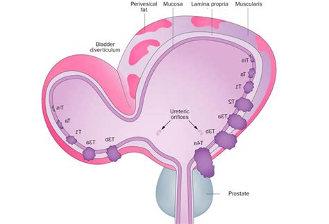 Bladder Diverticulum - Signs and Symptoms, Treatment in India