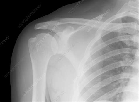 Normal shoulder, X-ray - Stock Image C010/3493 - Science Photo Library