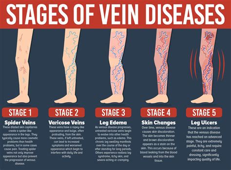 San Diego Varicose Vein Treatment | The Secret Vein Clinic in La Jolla, CA