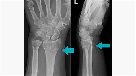 Xrays Of Broken Wrist