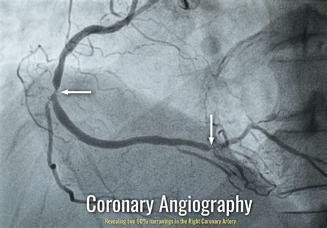 Coronary Arteries Angiography