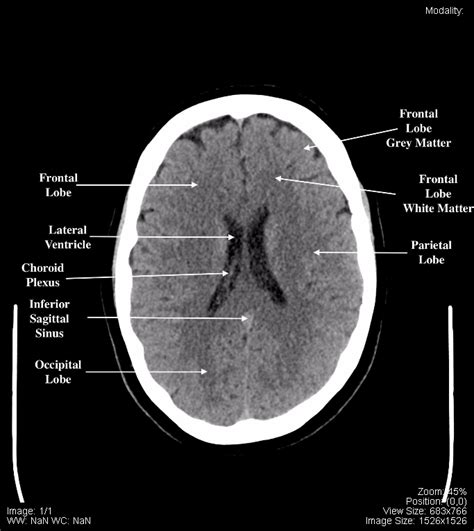 CT Scan Tips & Protocols: CT BRAIN ANATOMY