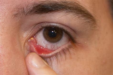 Eye Stye - Causes, Symptoms, Treatment, Pictures | Stye Eye | Stye in ...