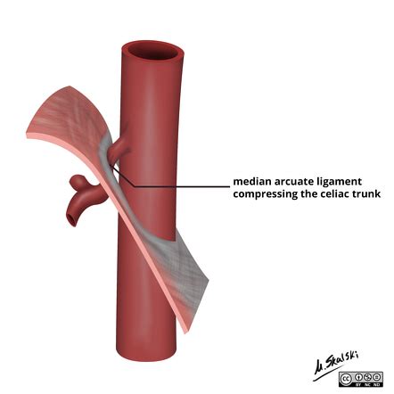 Arcuate Ligament Syndrome