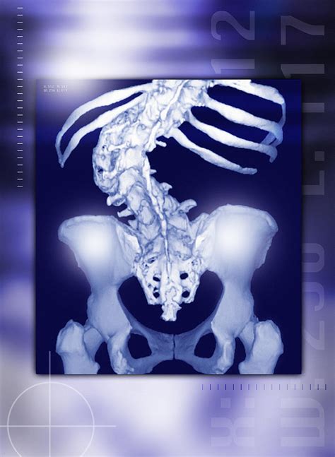 Osteoporosis Of The Spine, Ct Scan Photograph by Miriam Maslo | Fine ...