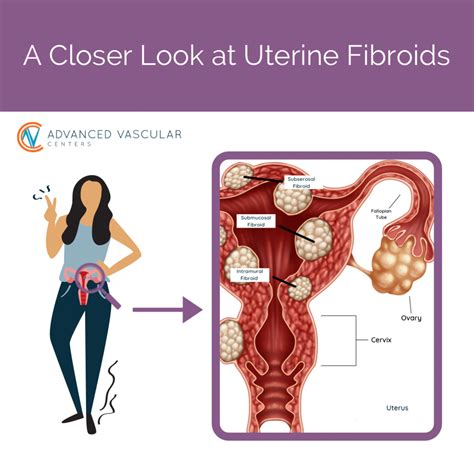 What Does It Mean If I Have Uterine Fibroids?