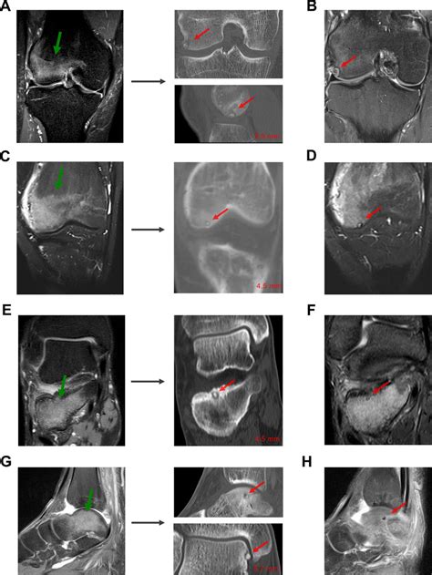 Extensive bone marrow edema as a presentation of intra-articular ...