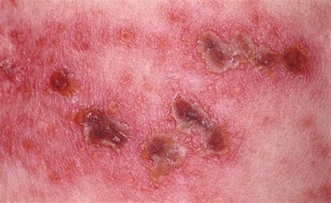 What Does Shingles Look Like Shingles Rash Pictures – Otosection