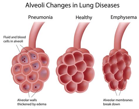 Chronic Cough - Pediatric Pulmonologists