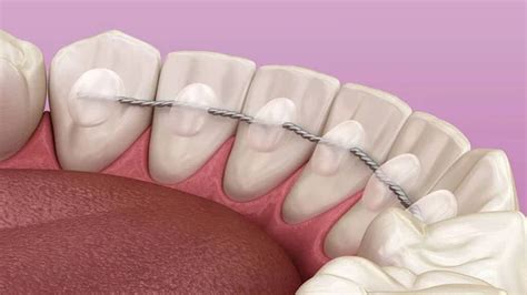 Lingual Braces: Pros, Cons, Cost, And Comfort