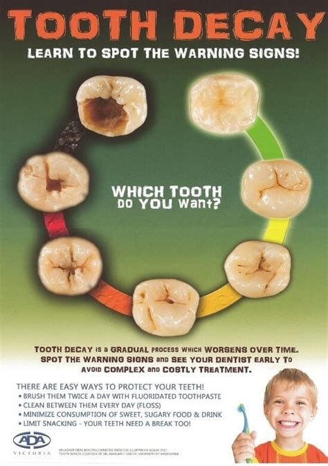 Nijjar Dental Blog: What does a cavity look like?