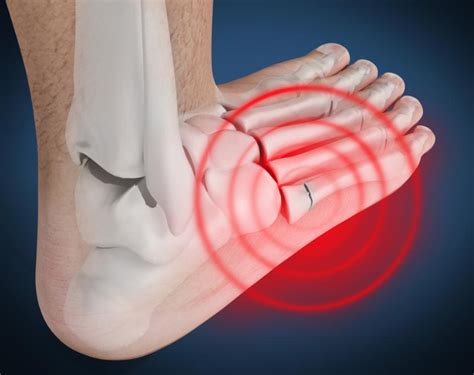 1St Metatarsal Pain Top Of Foot : Radiographic Views And Associated ...