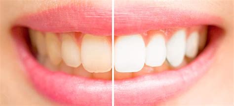 Tea and Coffee Teeth Stains: How To Remove Them - Dentist in Arkansas ...