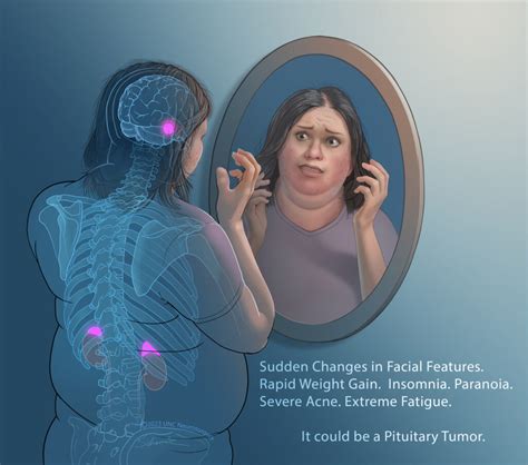 Pituitary Tumor Surgery | Department of Neurosurgery