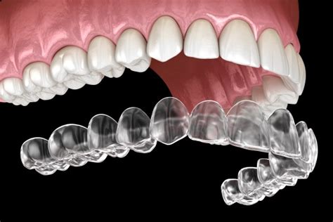 Invisalign® is a Popular Option for Teeth Straightening - Smiles Dental ...