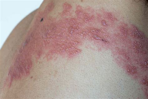 What Does Shingles Look Like? Shingles Rash Pictures