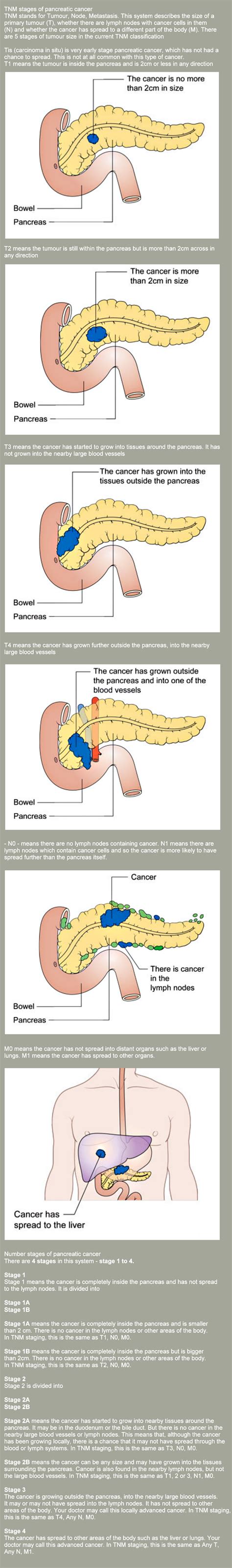 Stages of Pancreatic Cancer