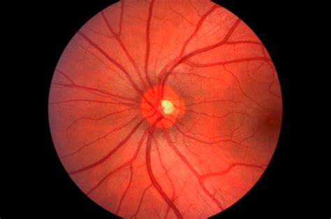 Retinal fundoscopy