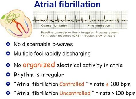 1000+ images about A FIB, Atrial Fibrillation on Pinterest | Heart ...