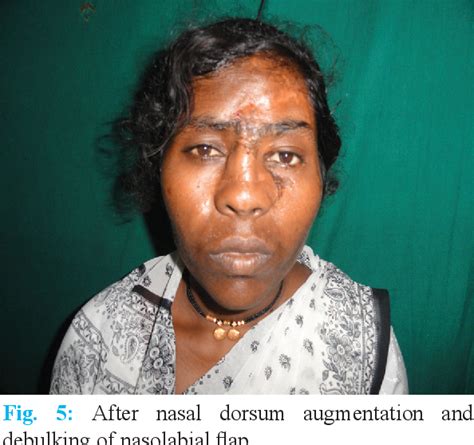 Figure 2 from Face Avulsion and Degloving | Semantic Scholar