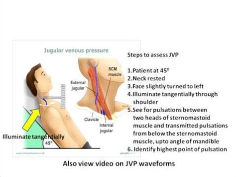 Jugular Venous Pressure Assessment