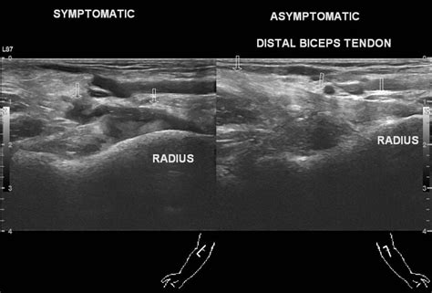 Distal Biceps Rupture Ultrasound