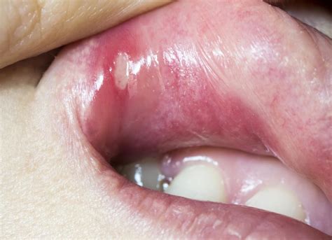 Mouth ulcers: Types, causes, symptoms, and treatment