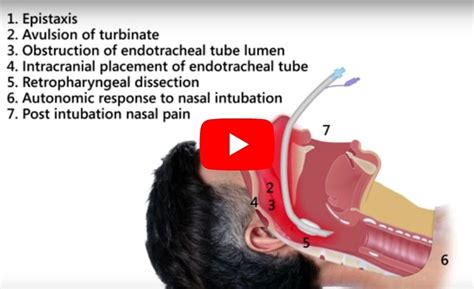 Video | Genesis Airway Innovations