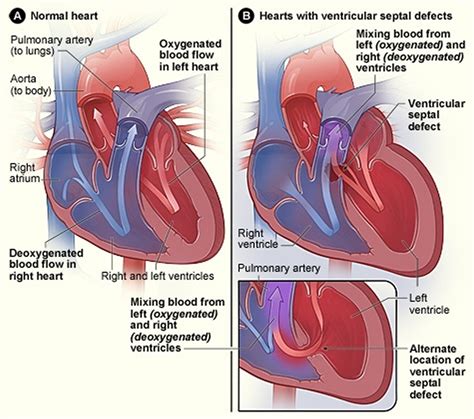 What is Congenital Heart Disease - Types, Causes, and Symptoms