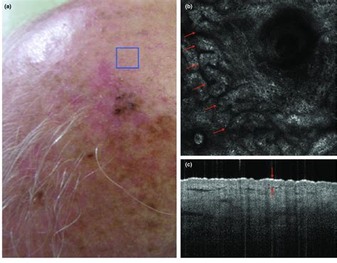 A subject with photoaging characterized by pigmentation and solar ...