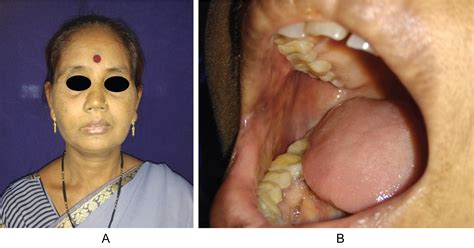 Inclusion Cyst Mouth