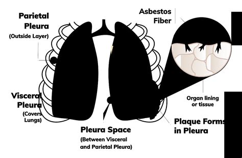 Pleural Mesothelioma | Treatment, Prognosis & Survival