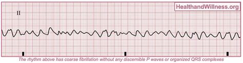 ECG: Basic Interpretation Jeopardy Template