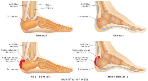 What is Bursitis of Heel? Shuman Podiatry & Sports Medicine - Foot Care