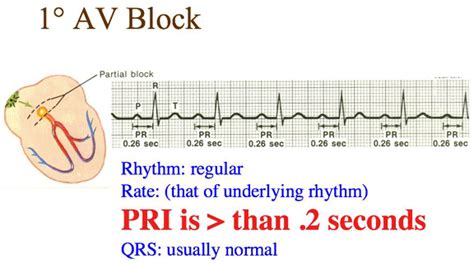 Atrioventricular Block