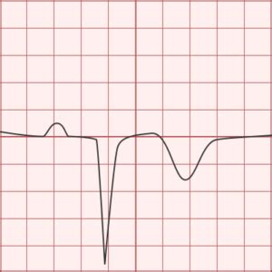 Pathologic Q-wave - Differential Diagnosis of