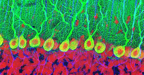 ET, Purkinje Cells, and Empty Basket Cells - Sperling Neurosurgery ...