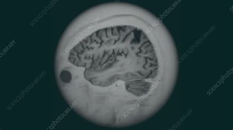 Brain atrophy, 3D MRI scan - Stock Video Clip - K005/5752 - Science ...