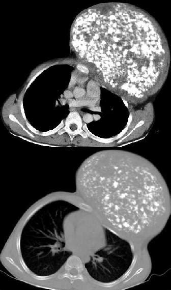 Thoracic Chondrosarcoma - radRounds Radiology Network