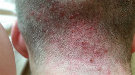 Irritated hair follicles, causes, symptoms, diagnosis & treatment