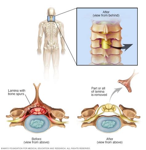 Laminectomy | Procedure, Preparation and Recovery | Neuroaxis