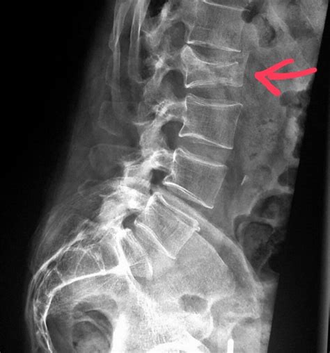 #Lumbar #spine #xray shows a #compression #fracture in an #elderly # ...