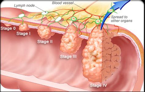 Cáncer de Colon | Biología y Geología 3ºESO