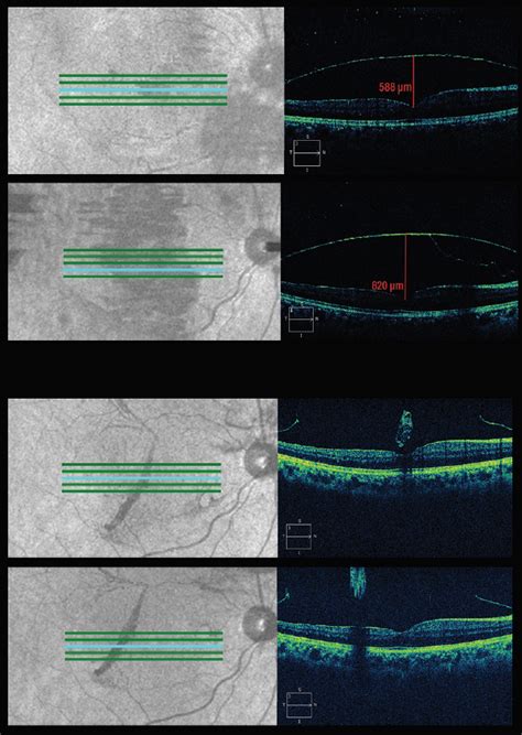 Tracking a Case of Valsalva Retinopathy - Retina Today